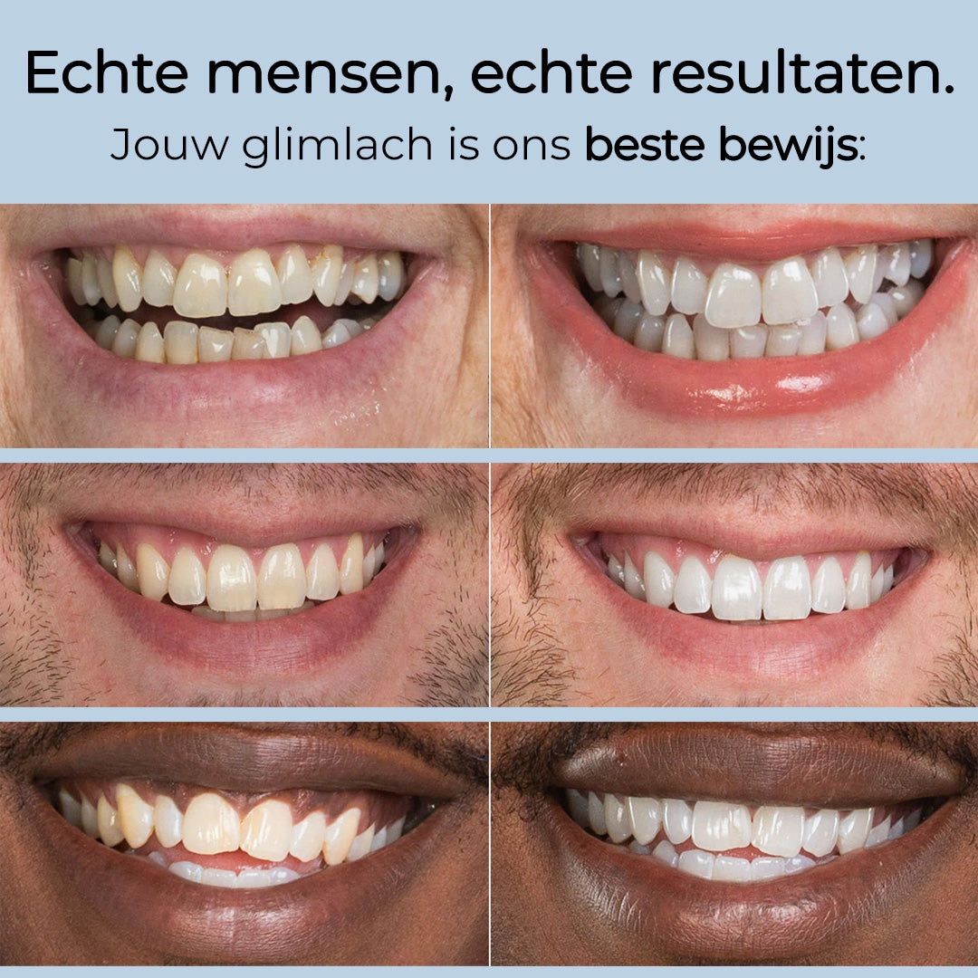 DentaGlow™ - Premium Tandenbleekset